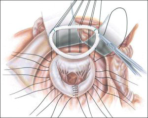 images/services/mitral-valve-reconstruction/mitral-valve-reconstruction-1.jpg