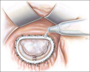 images/services/mitral-valve-reconstruction/mitral-valve-reconstruction-2.jpg